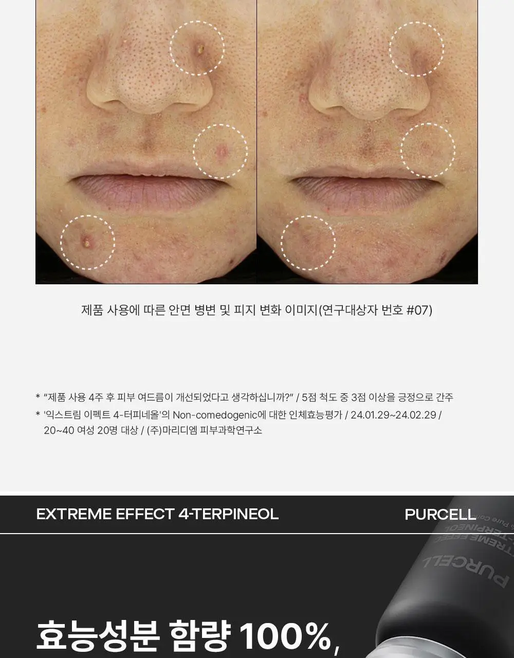 [트러블케어/스팟진정] 퍼셀 익스트림 이펙트 터피네올 원액 10ml 상세페이지 5